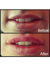 Beauty Naturale Aesthetics 1ml Dermal Lip filler with Emervel Classic - BNA Aesthetics