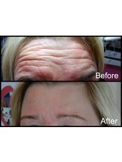 Beauty Naturale Aesthetics anti-wrinkle injections to the forehead and glabellar region - BNA Aesthetics