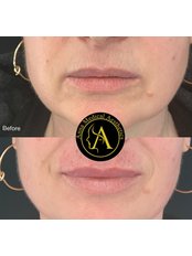 Lip Fillers - Anna Medical Aesthetics