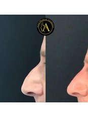 Non-Surgical Nose Job - Anna Medical Aesthetics