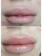 Lip Augmentation - Aqua-G Salon