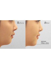 Dermal Fillers - Muse Clinic