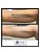 Extinkt Tattoo Removal Specialists - Suite G.06/1 VUE Buiding, Centennial Drive, Campbelltown, New South Wales, 2560,  1