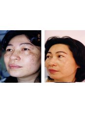 Pigmentation treatment  - Nuevo Cosmetic Clinic