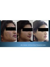 Acne Facial - Nuevo Cosmetic Clinic