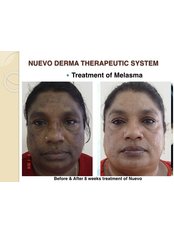 Skin pigmentation - Nuevo Cosmetic Clinic