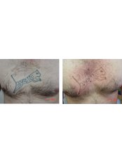 Tattoo removal using  Laser  - Nuevo Cosmetic Clinic