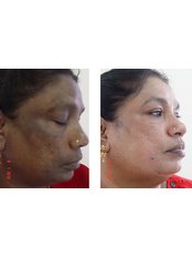 Age Spots Removal - Nuevo Cosmetic Clinic