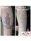 Fade to Blank Tattoo Removals - 67 Renwick St, Leichhardt, NSW, 2040,  2