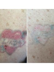 Tattoo Removal, Modify or Fade - No Regrets Laser Tattoo Removal