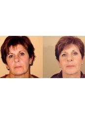 Non-Surgical Facelift - Antech Hair and Skin Clinics - Mississauga
