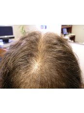 Hair Loss Treatment - Antech Hair and Skin Clinics - Mississauga