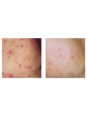 Acne Facial - Antech Hair and Skin Clinics - Mississauga