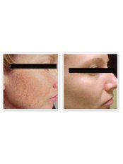 Pigmentation Treatment - Antech Hair and Skin Clinics - Mississauga