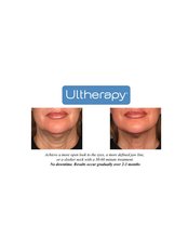 Ultherapy - Lasting Looks Clinic