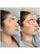 Lumilaser - Dermaplaning Facial at Lumilaser, Montreal, Quebec and Canada 