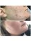 Lumilaser - Acne and Acne Scars, Blemishes, Skin Imperfections  