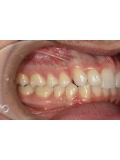 Dental Bridges - Medodent