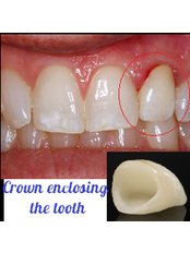 Dental Crowns - Medodent
