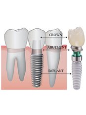 Dental Implants - Medodent