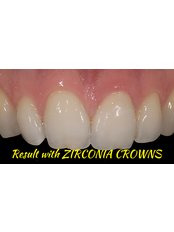 Zirconia Crown - Medodent