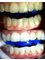 Laser Teeth Whitening Dublin - Unit 2, 48 Rushbrook, Blanchardstown, Dublin, Dublin 15,  2