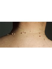 Skin tag removal - Advanced Electrolysis Clinic