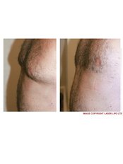 Laser Lipolysis - Dublin Skin and Laser Clinic