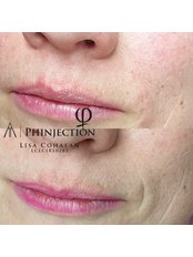 Phinjection Lip Filler  - Microblading Limerick