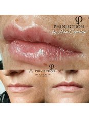 Phinjection Lip Filler  - Microblading Limerick