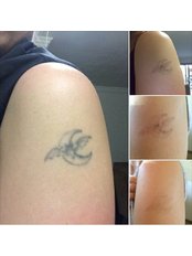 Laser Tattoo Removal - Pureskin Lab