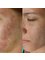 Lucia Biermanski Micropigmentation & Aesthetics - Microneedling treatment  