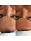 Toddington Laser Clinic - Geneo Facial including RF 