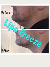 Lipo Freeze - Crouch Road, Grays, Chelmsford, RM164BX, 
