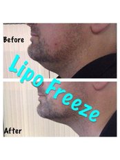 Lipo Freeze - Crouch Road, Grays, Chelmsford, RM164BX,  0