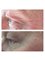ALW Aesthetics - Before and after treatment on crows feet / laughter lines. One treatment 
