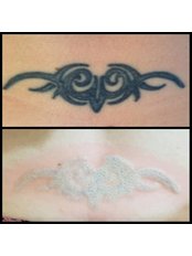 Tattoo Removal - Black Letter Tattoo Studio