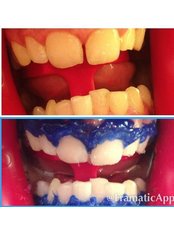 Teeth Whitening - Pure Skin Laser Clinic