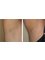 Herts Laser and Beauty Clinic - IPL hair removal underarm 