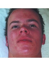 Acne Facial - BeauSynergy