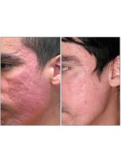 Acne Scars Treatment - BeauSynergy
