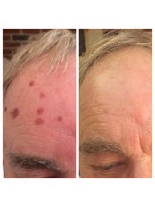 Age Spots Removal - BeauSynergy