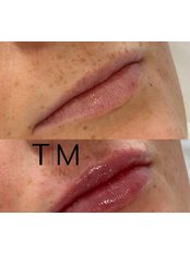 Lip Augmentation - Ta Moko Beauty Ltd
