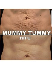Before 1st & After 3rd Treatment HIFU Body. - ReshapeU Beauty Clinic  with Hull Laser Treatments