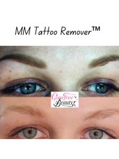Permanent Makeup Correction/Removal - Carefree Beauty Studio