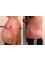 3D Body Contouring - After 3D Lipo Course 