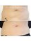 3D Body Contouring - Radio Frequency Skin Tightening 1 session 