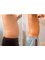 3D Body Contouring - After 4 sessions of 3D Lipo 