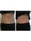 3D Body Contouring - Just 1 Skin Tightening Treatment  