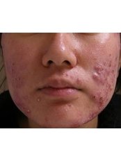 Acne Facial - Skin Deep Permanent Makeup